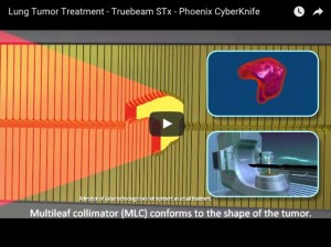 TrueBeam STx lung tumor imaging